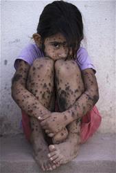 Aixa Cano, 5, who has hairy moles all over her body that doctors can't explain.   (AP Photo/Natacha Pisarenko)